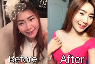 รีวิวตัดไขมันกระพุ้งแก้ม HERS Clinic