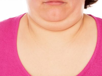 How To Lose Neck Fat 990×657