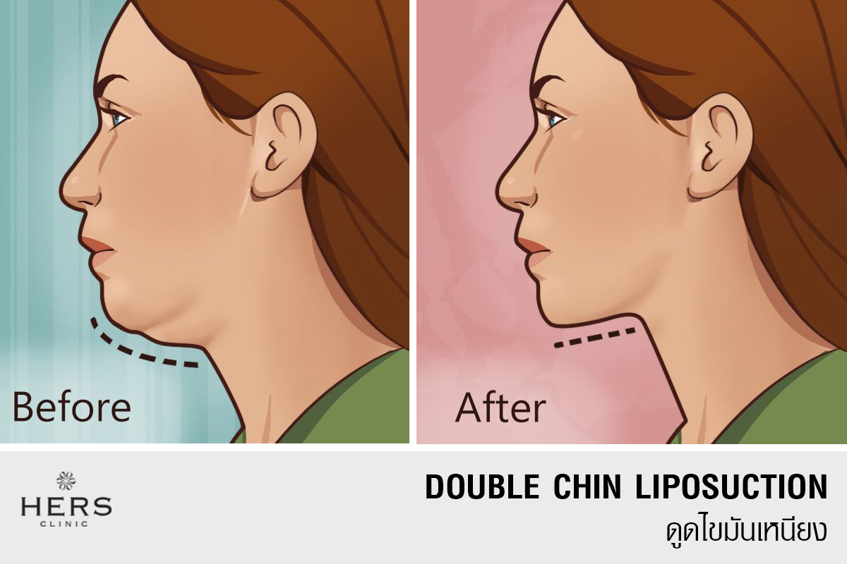 Doublechin Liposuction