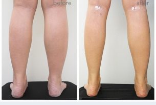 SLIM LEG นวัตกรรมศัลยกรรมขาเรียว