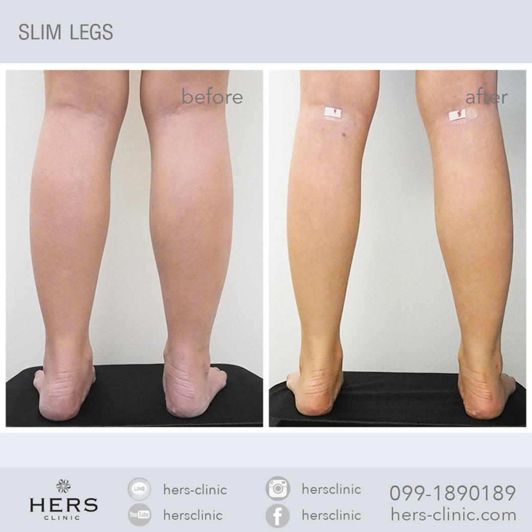 SLIM LEGS ผ่าตัด RF น่องเรียยว