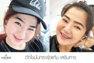 เสริมคาง ผ่าตัดลดไขมันแก้ม