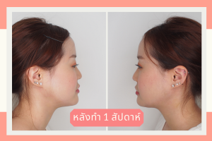 ก่อนทำ - หลังทำ Necktite