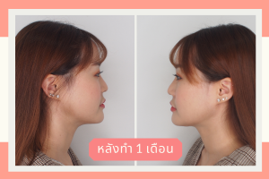 ก่อนทำ - หลังทำ Necktite