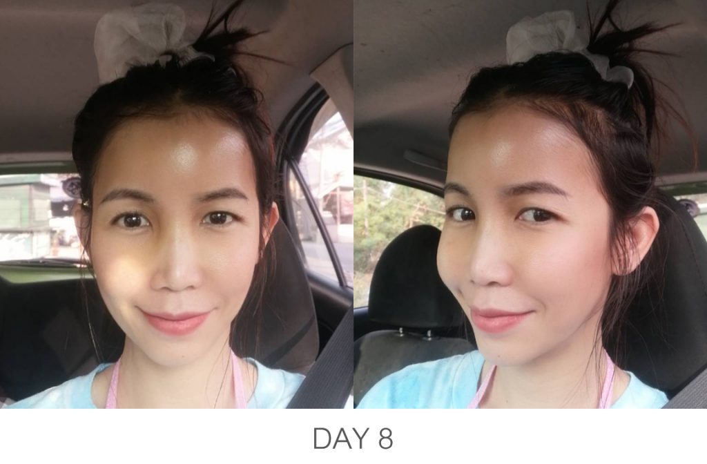 Day 8 เสริมหน้าผาก รีวิวเสริมหน้าผาก