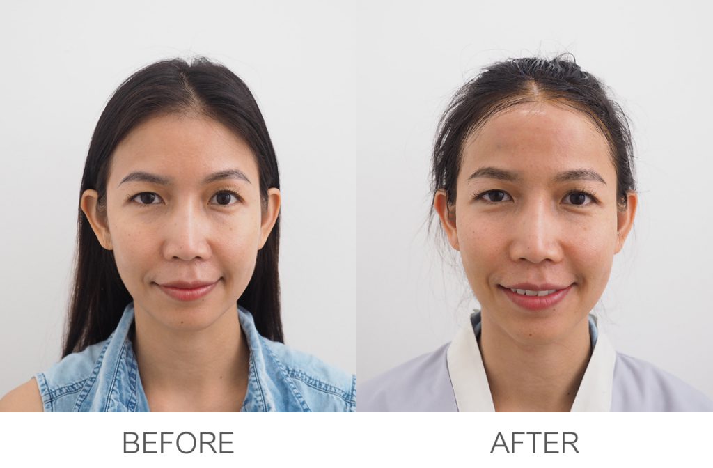 เสริมหน้าผาก before-after