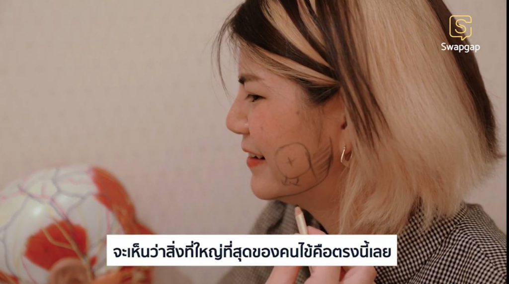 ตัดไขมันกระพุ้งแก้ม