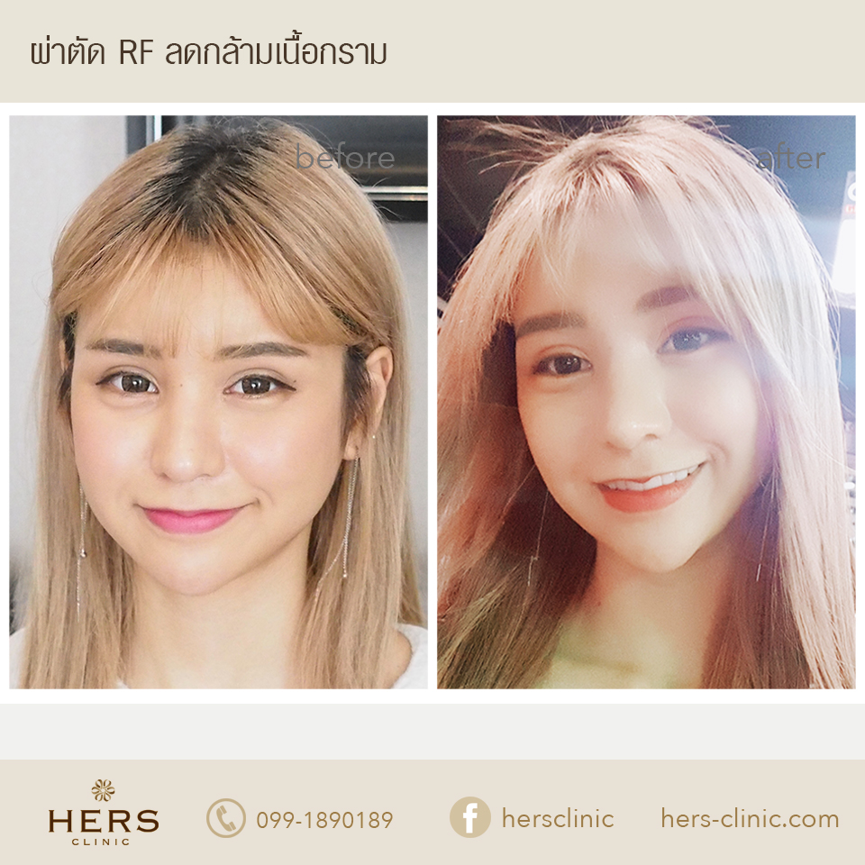 รีวิว RF ลดกล้ามเนื้อกราม Hers clinic