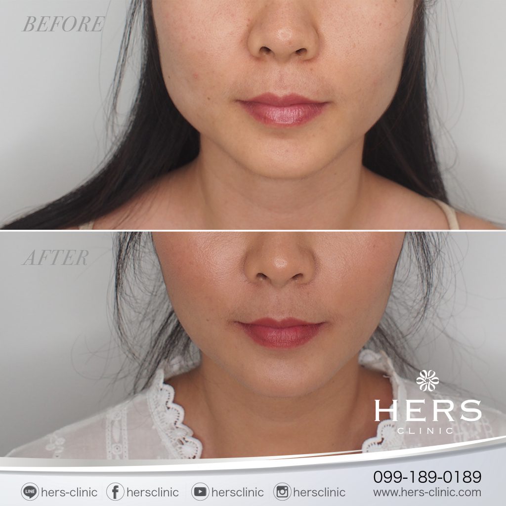 รีวิว RF ลดกล้ามเนื้อกราม Hers clinic