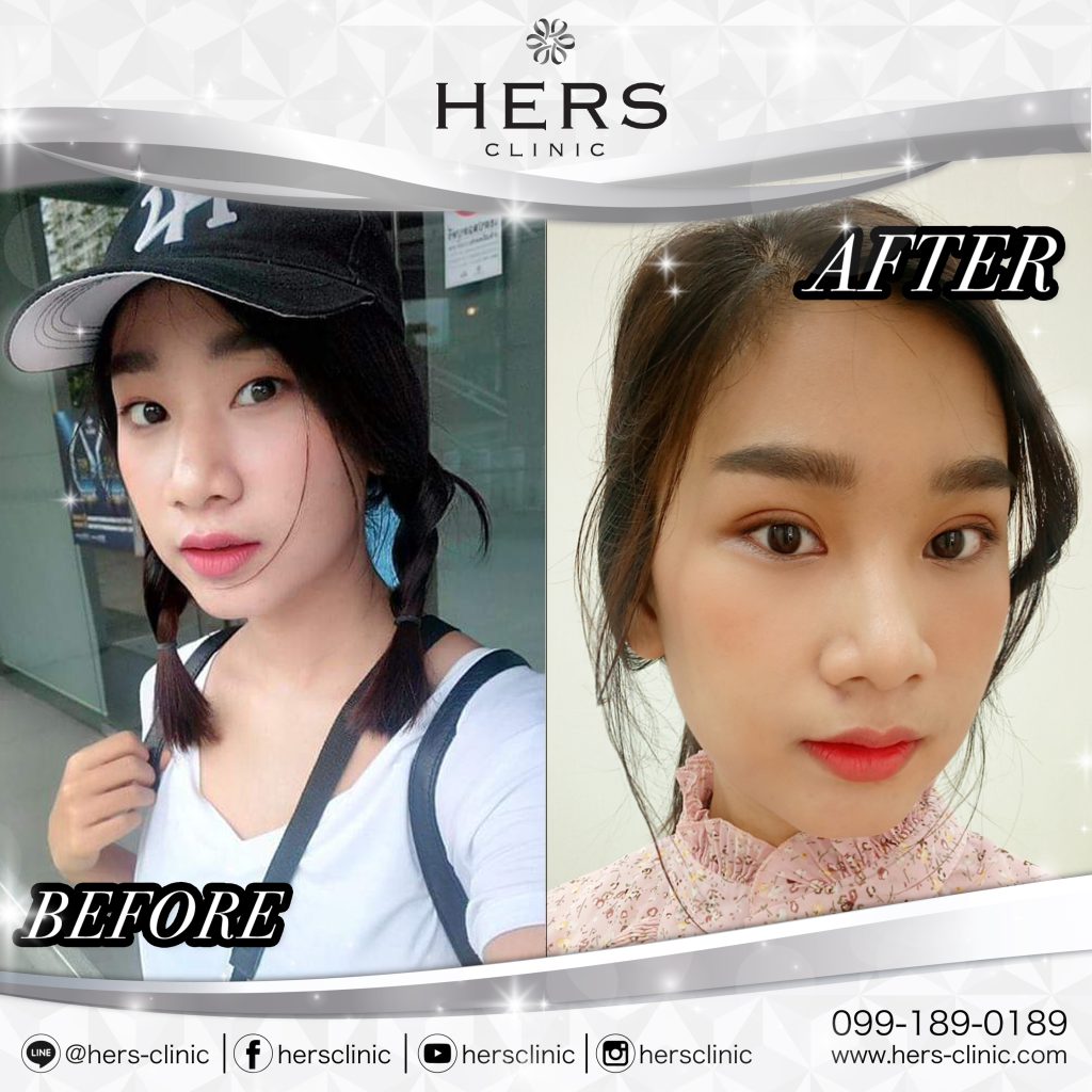 รีวิวทำตา2ชั้น Hers clinic สร้างชั้นตา