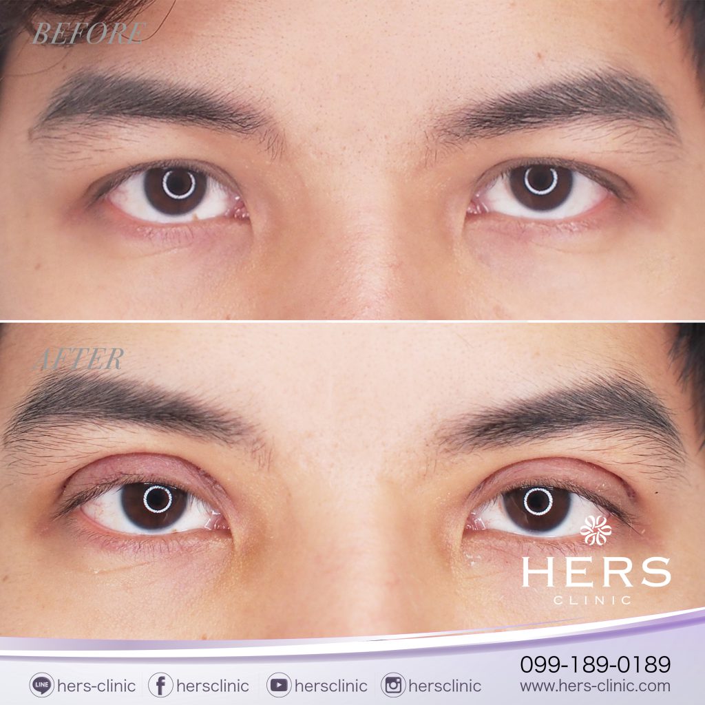 รีวิวทำตา2ชั้น Hers clinic สร้างชั้นตาเป็นธรรมชาติ