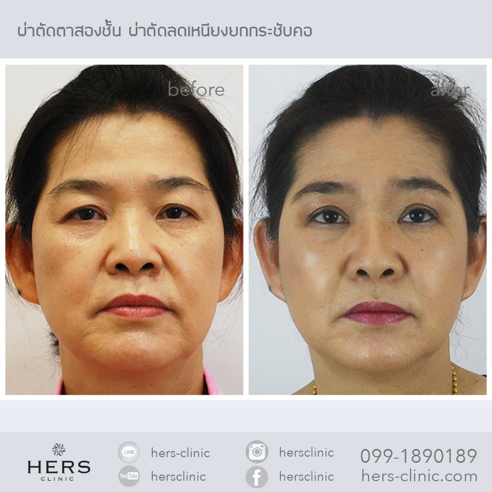 รีวิวทำตา2ชั้น Hers clinic สร้างชั้นตา