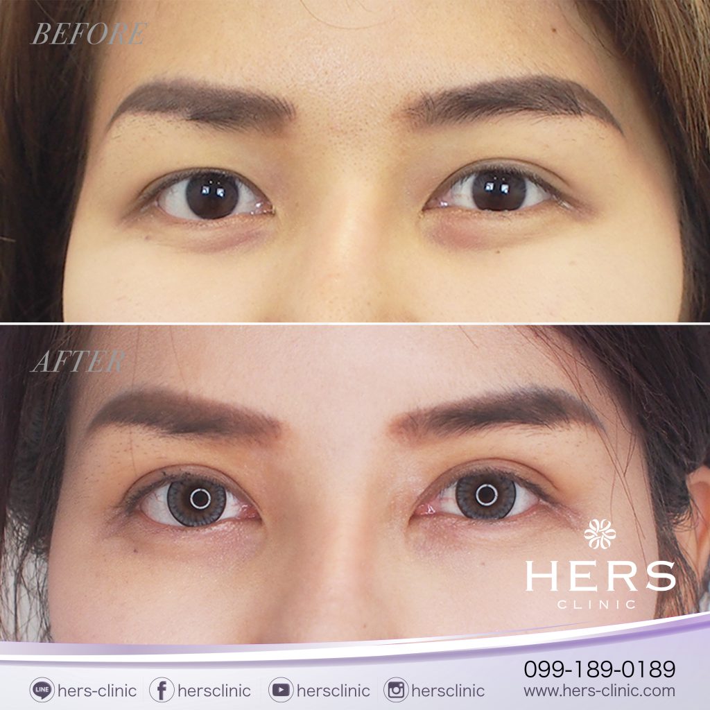 รีวิวทำตา 2 ชั้น Hers clinic