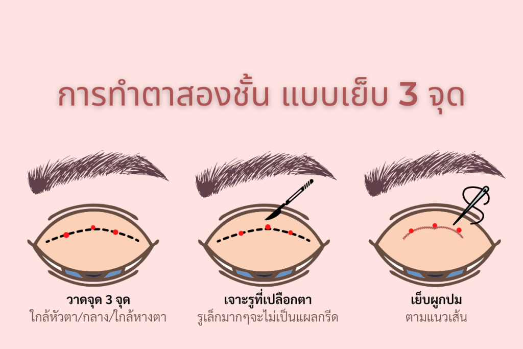 รีวิวทำตาสองชั้น Hers clinic