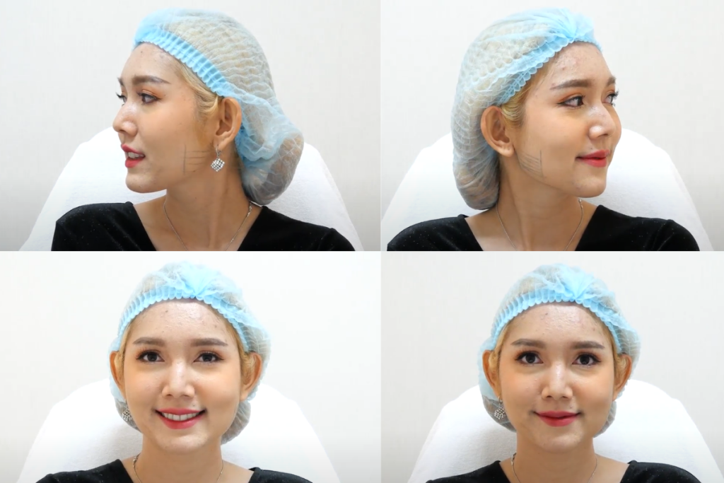 Botox ลดกราม Hersclinic