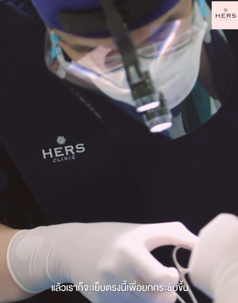 ตัดไขมันกระพุ้งแก้ม Hers clinic