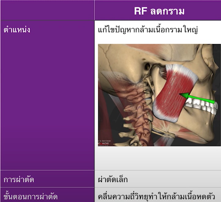 การผ่าตัด RFลดกล้ามเนื้อกรามเหมาะกับใคร