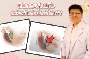 ไขข้อสงสัย ตัดไขมันกระพุ้งแก้มแล้ว ” แก้มห้อย ” จริงหรือไม่ ??