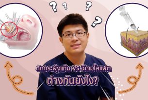 ตัดไขมันกระพุ้งแก้ม VS ฉีดเมโสแฟต ต่างกันยังไง?