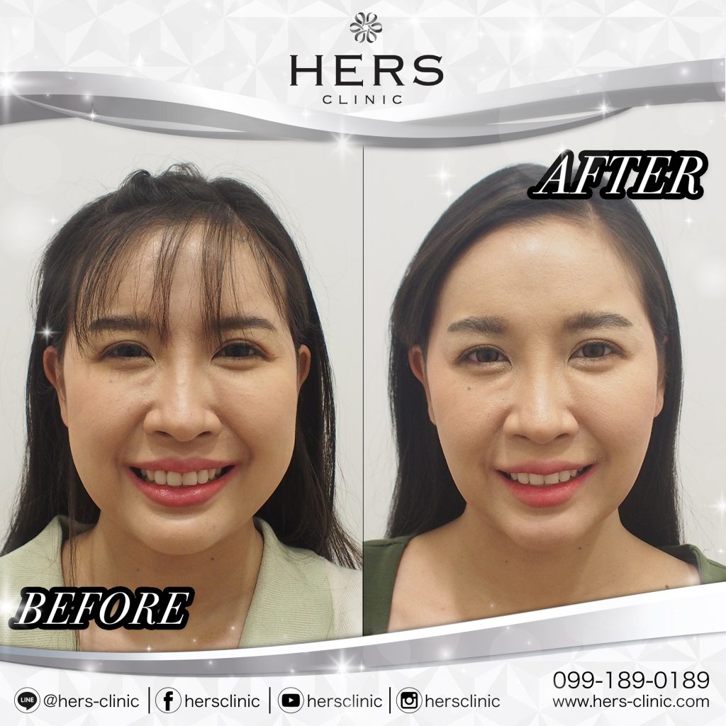 ตัดไขมันกระพุ้งแก้ม -HERS CLINIC