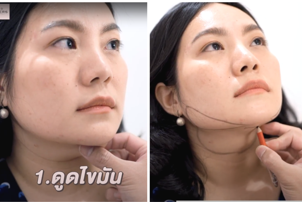 ผ่าตัดเหนียง HERS CLINIC