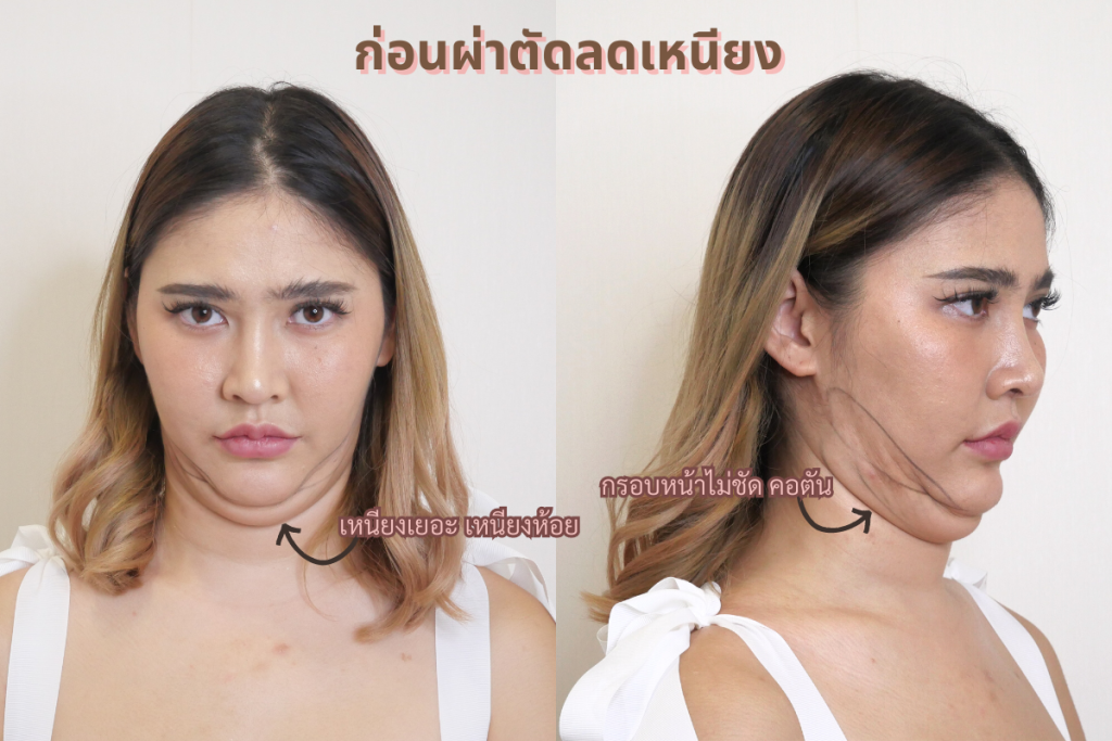 แผลภายนอกบริเวณใต้คางประมาณ 2.5-3 ซม.