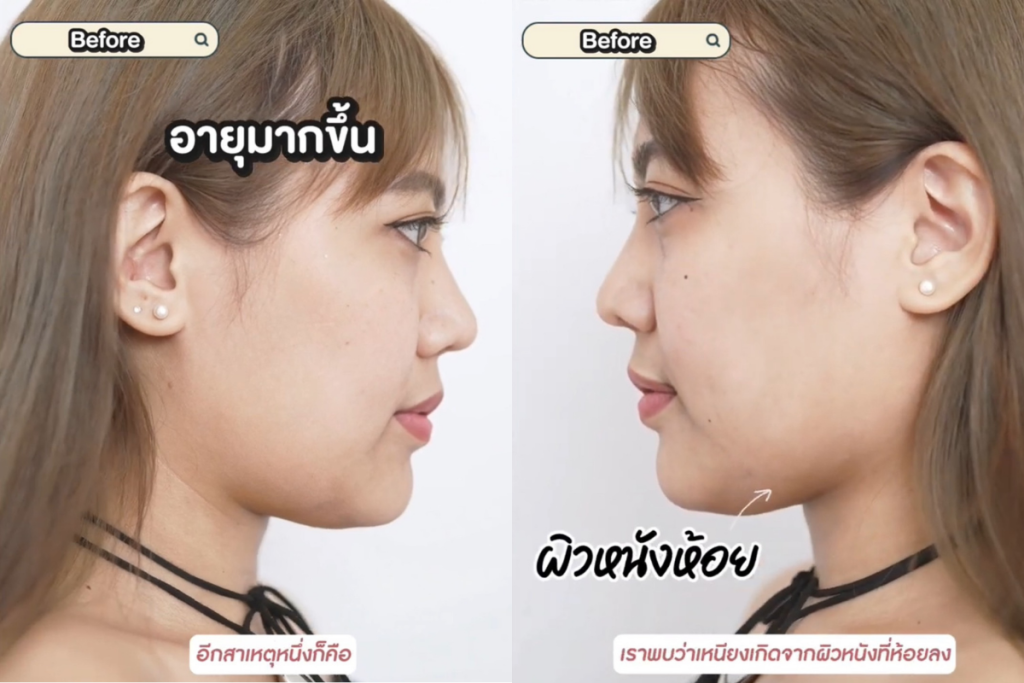 สาเหตุของการเกิดเหนียง 