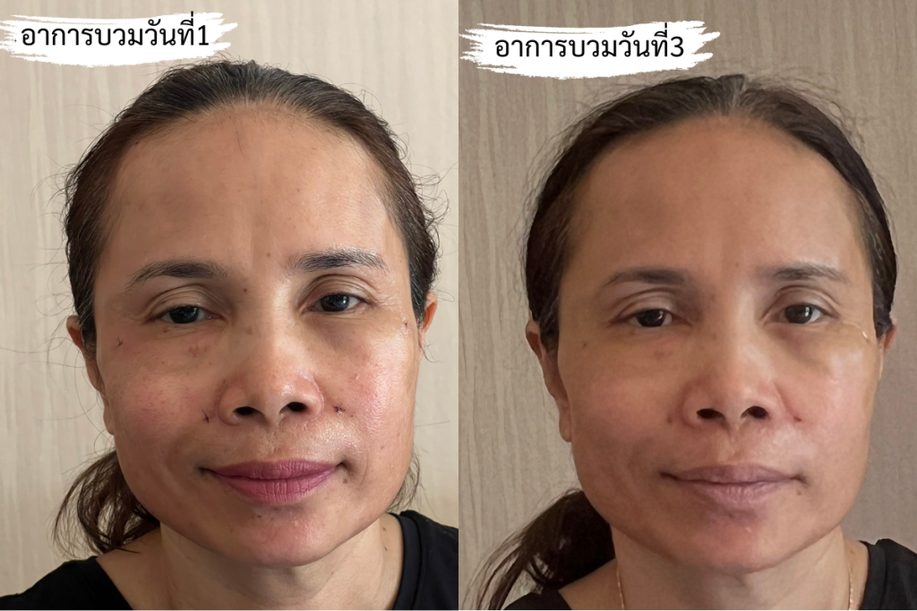 รีวิวอาการบวมหลังทำฉีดไขมันหน้าเด็ก 